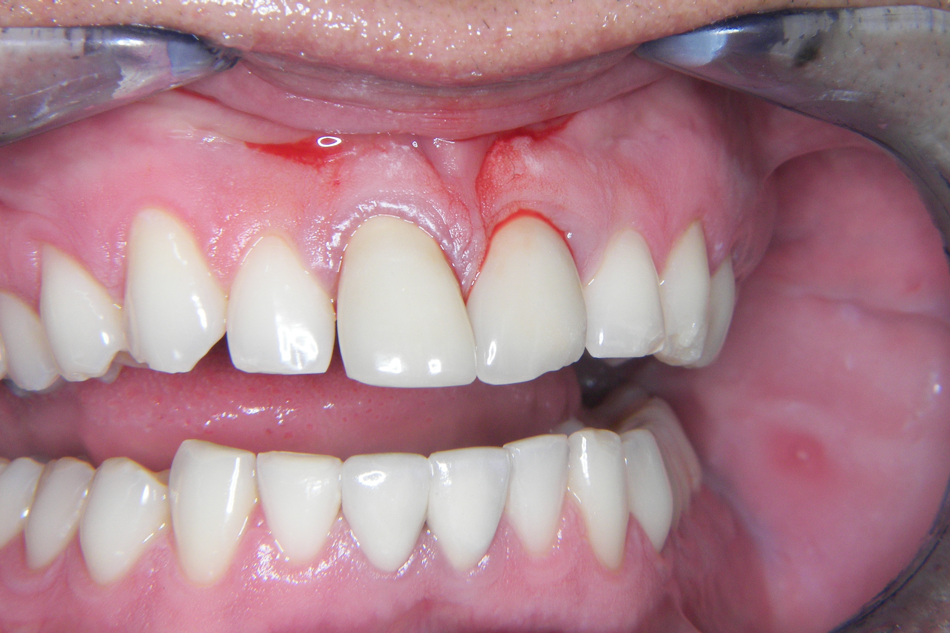 Amalgame Dentaire Dans Les Sinus