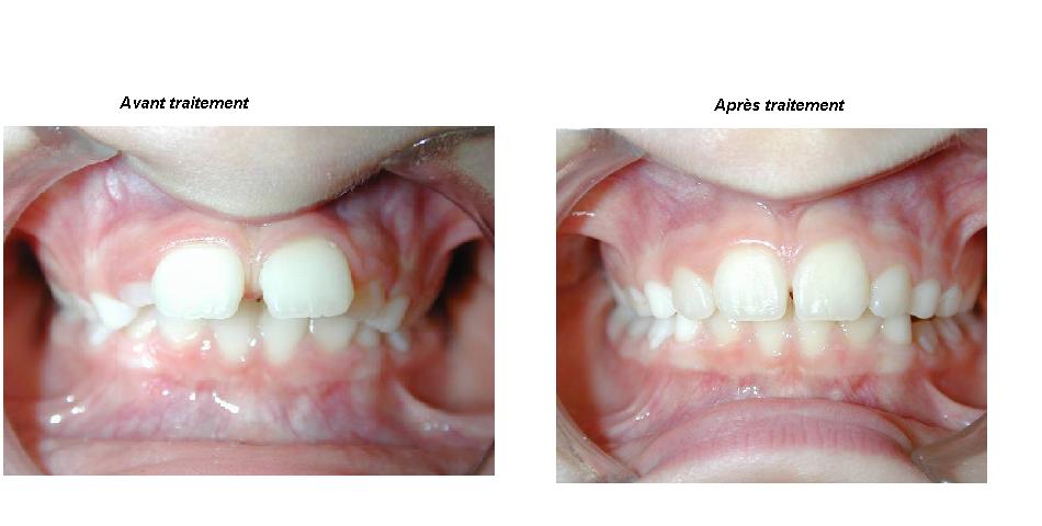 Orthodontie ado et adulte : Corriger l'alignement dents définitives - Dr  Gilbert