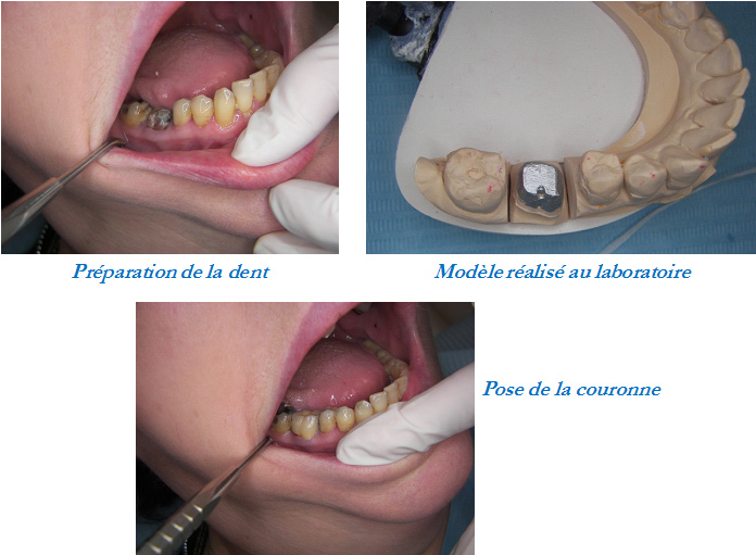 pose de Couronne dentaire : Restituer à l'identique une dent altérée