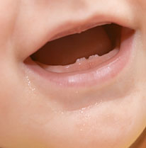 Problèmes de plombage dent – L'obturation dentaire débordée © 